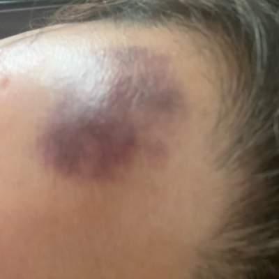 飲み過ぎて怪我ばかりするおばさん